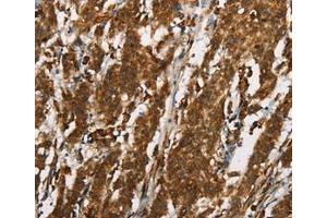 Immunohistochemical analysis of paraffin-embedded Human gastric cancer tissue using at dilution 1/25. (CTAG1A anticorps  (Internal Region))