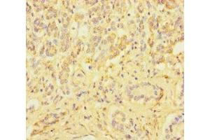 Immunohistochemistry of paraffin-embedded human pancreatic cancer using ABIN7176008 at dilution of 1:100 (ZSCAN29 anticorps  (AA 1-300))