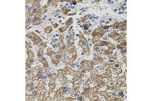 Immunohistochemistry of paraffin-embedded human liver injury using NTF3 antibody (ABIN6290617) (40x lens). (Neurotrophin 3 anticorps)