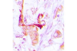 Immunohistochemical analysis of EEF2 staining in human lung cancer formalin fixed paraffin embedded tissue section.