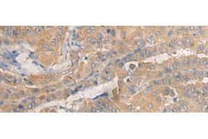 Immunohistochemistry of paraffin-embedded Human thyroid cancer tissue using AGAP3 Polyclonal Antibody at dilution of 1:25(x200) (AGAP3 anticorps)