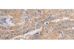 Immunohistochemistry of paraffin-embedded Human thyroid cancer tissue using AGAP3 Polyclonal Antibody at dilution of 1:25(x200)