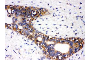 Anti- AGTR1 Picoband antibody, IHC(P) IHC(P): Human Mammary Cancer Tissue