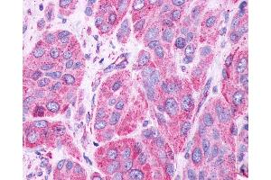 Anti-GPR61 antibody IHC of human Skin, Melanoma.