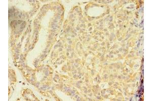 Immunohistochemistry of paraffin-embedded human breast cancer using ABIN7166213 at dilution of 1:100 (SEC31A anticorps  (AA 335-503))