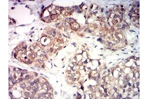 Immunohistochemical analysis of paraffin-embedded bladder cancer tissues using KMT5A mouse mAb with DAB staining.