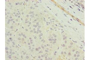 Immunohistochemistry of paraffin-embedded human liver cancer using ABIN7173103 at dilution of 1:100 (TMEM177 anticorps  (AA 219-311))