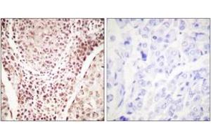Immunohistochemistry analysis of paraffin-embedded human breast carcinoma, using Chk2 (Phospho-Thr387) Antibody. (CHEK2 anticorps  (pThr387))