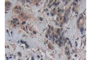 Detection of Cys-C in Human Breast cancer Tissue using Polyclonal Antibody to Cystatin C (Cys-C) (Cystathionine-gamma-Synthase Precursor (CYS) (AA 27-146) anticorps)