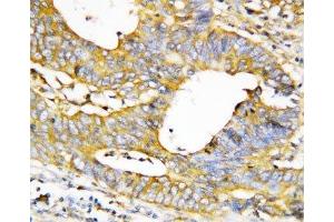 IHC-P testing of human breast cancer tissue