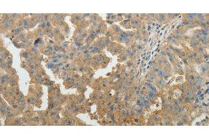 Immunohistochemistry of paraffin-embedded Human ovarian cancer tissue using SYT6 Polyclonal Antibody at dilution 1:40 (SYT6 anticorps)