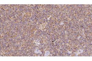 ABIN6273196 at 1/100 staining Human lymph cancer tissue by IHC-P.