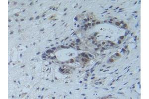Detection of Raftlin in Human Pancreas Cancer Tissue using Polyclonal Antibody to Raft Linking Protein (Raftlin)