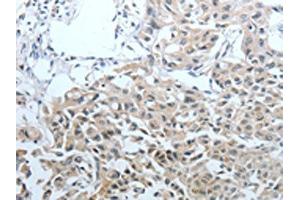 The image on the left is immunohistochemistry of paraffin-embedded Human lung cancer tissue using ABIN7128892(CEACAM1 Antibody) at dilution 1/25, on the right is treated with fusion protein. (CEACAM1 anticorps)