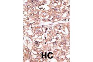 Formalin-fixed and paraffin-embedded human hepatocellular carcinoma tissue reacted with TLR7 polyclonal antibody  , which was peroxidase-conjugated to the secondary antibody, followed by AEC staining. (TLR7 anticorps  (N-Term))