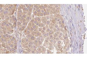 ABIN6273781 at 1/100 staining Human Melanoma tissue by IHC-P.