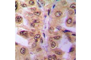 Immunohistochemical analysis of SIAH2 staining in human breast cancer formalin fixed paraffin embedded tissue section.