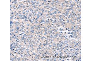 Immunohistochemistry of Human prostate cancer using ROR1 Polyclonal Antibody at dilution of 1:35 (ROR1 anticorps)