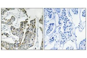 Immunohistochemical analysis of paraffin-embedded human breast carcinoma tissue using BLK (Phospho-Tyr501) antibody (left)or the same antibody preincubated with blocking peptide (right). (BLK anticorps  (pTyr501))