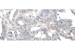 Immunohistochemistry of paraffin-embedded Human liver cancer tissue using NOG Polyclonal Antibody at dilution of 1:50(x200) (NOG anticorps)