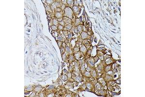Immunohistochemistry of paraffin-embedded human breast cancer using β-Catenin antibody (ABIN7266137) at dilution of 1:100 (40x lens).