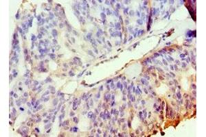 Immunohistochemistry of paraffin-embedded human endometrial cancer using ABIN7169127 at dilution of 1:100 (PAK2 anticorps  (AA 1-212))