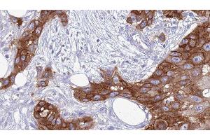 ABIN6277559 at 1/100 staining Human Head and neck cancer tissue by IHC-P. (TYROBP anticorps  (C-Term))