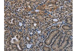 The image on the left is immunohistochemistry of paraffin-embedded Human thyroid cancer tissue using ABIN7129587(GDF3 Antibody) at dilution 1/25, on the right is treated with fusion protein.