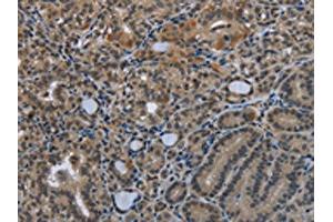 The image on the left is immunohistochemistry of paraffin-embedded Human thyroid cancer tissue using ABIN7129587(GDF3 Antibody) at dilution 1/25, on the right is treated with fusion protein. (GDF3 anticorps)