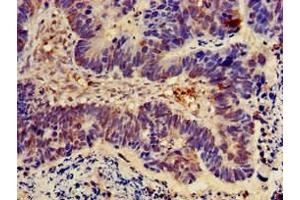 Immunohistochemistry of paraffin-embedded human ovarian cancer using ABIN7162073 at dilution of 1:100 (NOD2 anticorps  (AA 460-733))