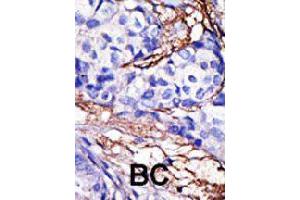 Formalin-fixed and paraffin-embedded human cancer tissue reacted with RBCK1 polyclonal antibody  , which was peroxidase-conjugated to the secondary antibody, followed by DAB staining. (RBCK1 anticorps  (N-Term))