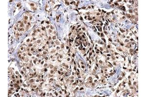 IHC-P Image SNRPD2 antibody detects SNRPD2 protein at nucleus on human breast carcinoma by immunohistochemical analysis.