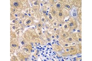 Immunohistochemistry of paraffin-embedded Human liver damage using CARD11 Polyclonal Antibody at dilution of 1:100 (40x lens). (CARD11 anticorps)