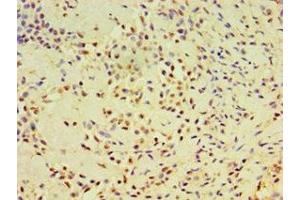 Immunohistochemistry of paraffin-embedded human breast cancer using ABIN7164384 at dilution of 1:100 (DHX58 anticorps  (AA 389-678))