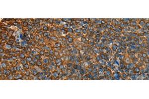 Immunohistochemistry of paraffin-embedded Human cervical cancer tissue using YBX1 Polyclonal Antibody at dilution of 1:25(x200)