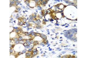 Immunohistochemistry of paraffin-embedded Human gastric cancer using AMY2A Polyclonal Antibody at dilution of 1:100 (40x lens). (AMY2A anticorps)