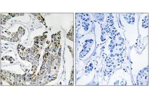 Immunohistochemistry analysis of paraffin-embedded human breast carcinoma, using BLK (Phospho-Tyr501) Antibody. (BLK anticorps  (pTyr501))