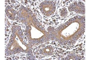IHC-P Image Immunohistochemical analysis of paraffin-embedded human colon carcinoma, using SERCA3, antibody at 1:500 dilution. (ATP2A3 anticorps  (N-Term))