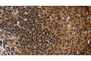 Immunohistochemistry of paraffin-embedded Human cervical cancer using FHL3 Polyclonal Antibody at dilution of 1:40