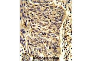Formalin-fixed and paraffin-embedded human lung carcinoma reacted with SNRPD1 Antibody (Center) (ABIN389356 and ABIN2839462) , which was peroxidase-conjugated to the secondary antibody, followed by DAB staining.