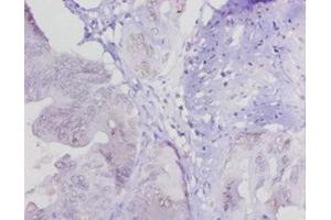 Immunohistochemistry of paraffin-embedded human colon cancer using ABIN7158833 at dilution of 1:20 (LOXL1 anticorps  (AA 106-574))