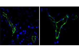 Immunofluorescence analysis of paraffin-embedded human lung cancer(left) and breast cancer(right) cells using CD31 mouse mAb (green). (CD31 anticorps)