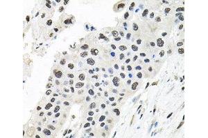 Immunohistochemistry of paraffin-embedded Human lung cancer using CDCA8 Polyclonal Antibody at dilution of 1:100 (40x lens). (CDCA8 anticorps)