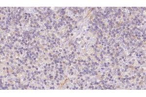 ABIN6273117 at 1/100 staining Human lymph cancer tissue by IHC-P.