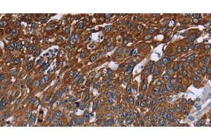 Immunohistochemistry of paraffin-embedded Human lung cancer tissue using FCGR3A Polyclonal Antibody at dilution 1:40 (FCGR3A anticorps)