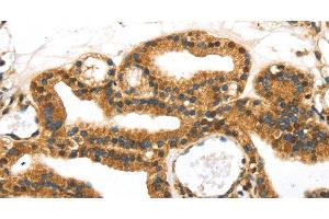 Immunohistochemistry of paraffin-embedded Human thyroid cancer tissue using SERPINB8 Polyclonal Antibody at dilution 1:40 (SERPINB8 anticorps)