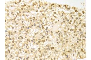 Immunohistochemistry of paraffin-embedded human kidney cancer using PLCB1 antibody. (Phospholipase C beta 1 anticorps)