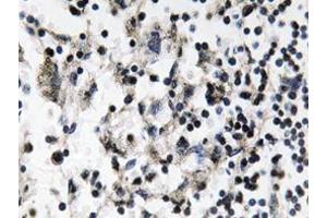 Immunohistochemistry analyzes of Catenin-β antibody in paraffin-embedded human breast carcinoma tissue. (CDC37 anticorps)