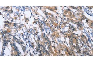 Immunohistochemistry of paraffin-embedded Human colon cancer using SYT17 Polyclonal Antibody at dilution of 1:60