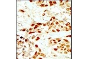 Formalin-fixed and paraffin-embedded human cancer tissue reacted with the primary antibody, which was peroxidase-conjugated to the secondary antibody, followed by DAB staining. (DAPK2 anticorps  (N-Term))